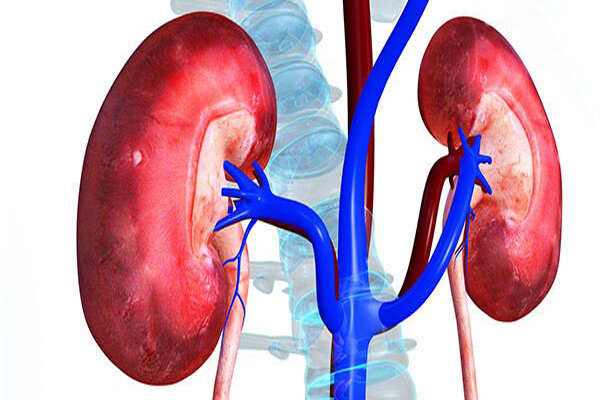 سنگ کلیه شایع ترین بیماری کلیوی در استان آذربایجان شرقی