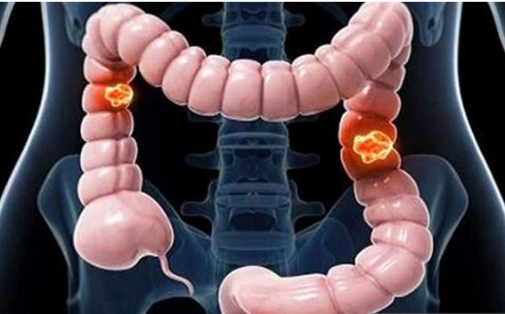 نقش کم خوابی و استرس در پیشرفت سرطان