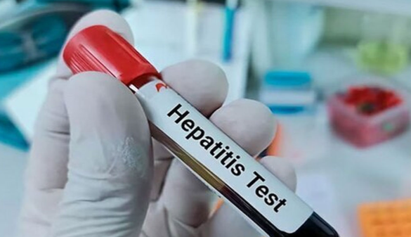 هشدار شیوع بالای هپاتیت A در کودکان و نوجوانان ایرانی